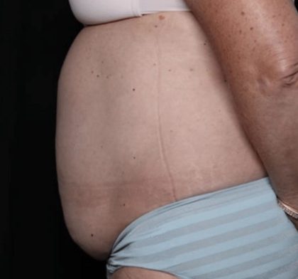 Liposuction Before & After Patient #32526