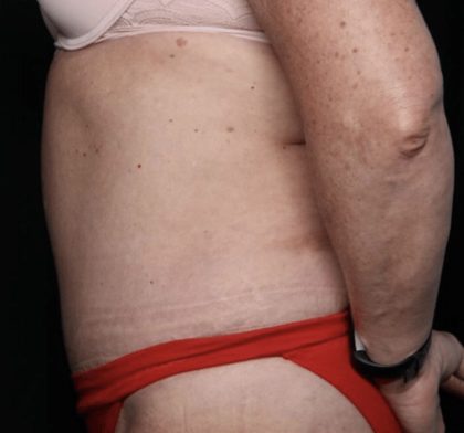 Liposuction Before & After Patient #32526