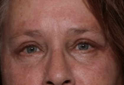 Blepharoplasty and Brow Lift Before & After Patient #32515