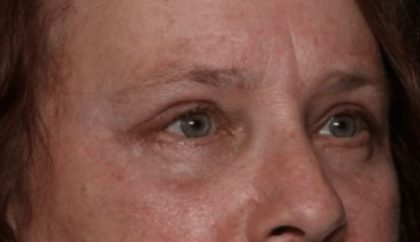 Blepharoplasty and Brow Lift Before & After Patient #32515