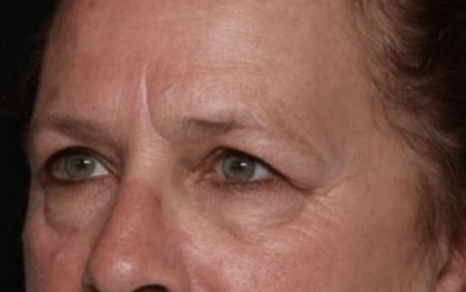 Blepharoplasty and Brow Lift Before & After Patient #32515