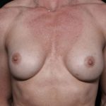 Breast Implant Exchange Before & After Patient #32535