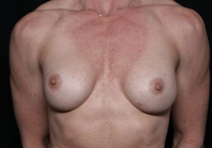 Breast Implant Exchange Before & After Patient #32535