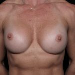 Breast Implant Exchange Before & After Patient #32535