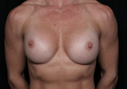 Breast Implant Exchange Before & After Patient #32535