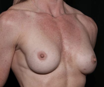 Breast Implant Exchange Before & After Patient #32535