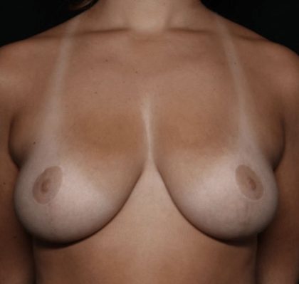 Breast Reduction Before & After Patient #32549