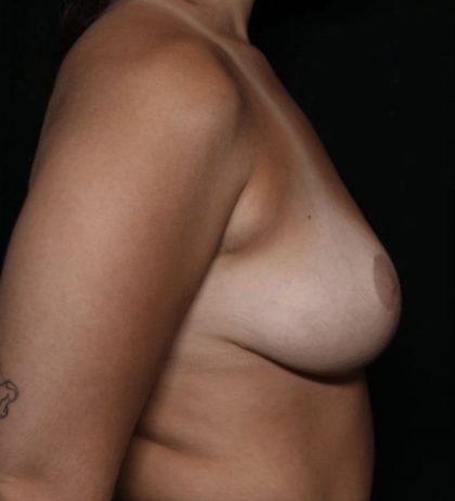 Breast Reduction Before & After Patient #32549