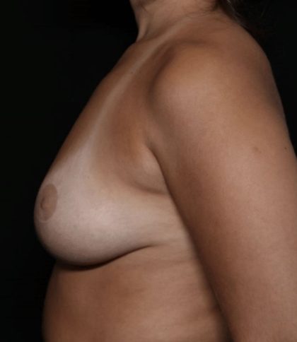 Breast Reduction Before & After Patient #32549