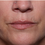 Lip Filler Before & After Patient #32629