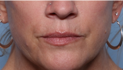 Lip Filler Before & After Patient #32629