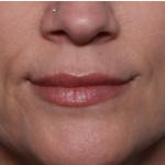 Lip Filler Before & After Patient #32629