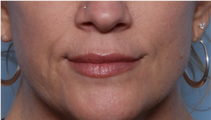 Lip Filler Before & After Patient #32629