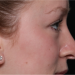 Rhinoplasty Before & After Patient #32572