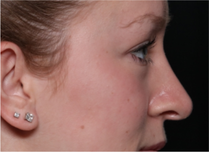 Rhinoplasty Before & After Patient #32572