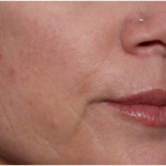 Lip Filler Before & After Patient #32629