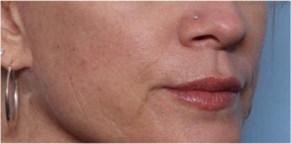 Lip Filler Before & After Patient #32629