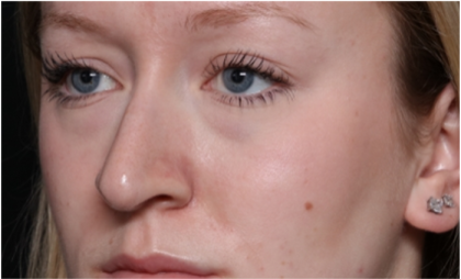 Rhinoplasty Before & After Patient #32572