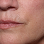 Lip Filler Before & After Patient #32629