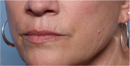 Lip Filler Before & After Patient #32629