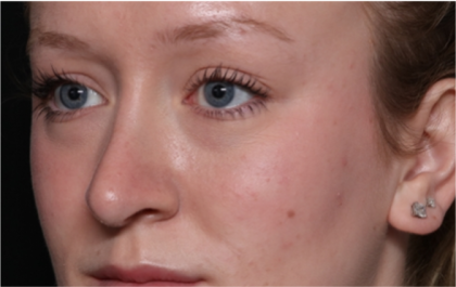 Rhinoplasty Before & After Patient #32572