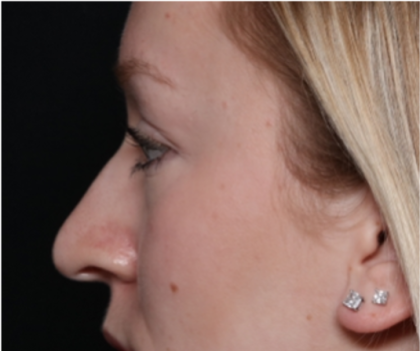 Rhinoplasty Before & After Patient #32572