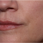 Lip Filler Before & After Patient #32629