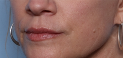 Lip Filler Before & After Patient #32629