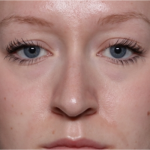 Rhinoplasty Before & After Patient #32572