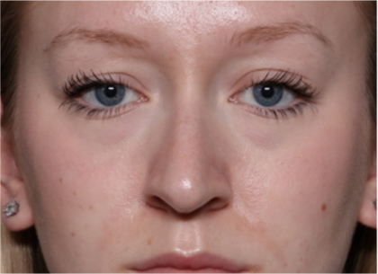 Rhinoplasty Before & After Patient #32572