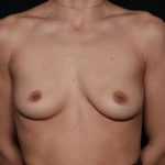 Breast Augmentation Before & After Patient #32571