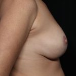 Breast Lift Before & After Patient #32648