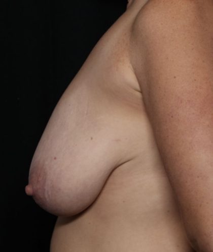 Breast Lift Before & After Patient #32648