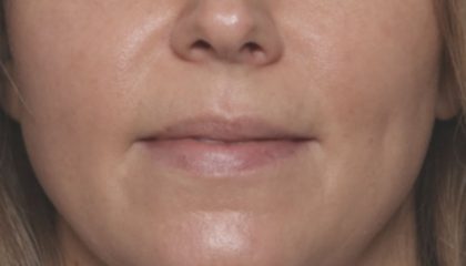Lip Filler Before & After Patient #32659