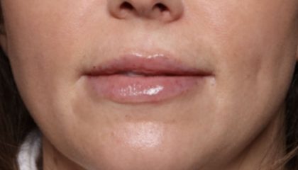 Lip Filler Before & After Patient #32659