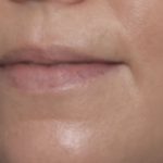 Lip Filler Before & After Patient #32659