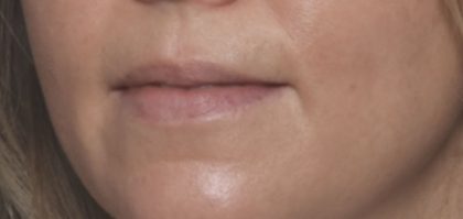 Lip Filler Before & After Patient #32659