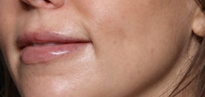 Lip Filler Before & After Patient #32659