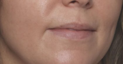 Lip Filler Before & After Patient #32659