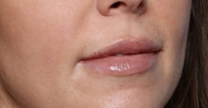 Lip Filler Before & After Patient #32659