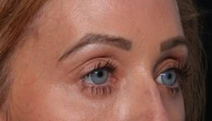 Brow Lift Before & After Patient #32830