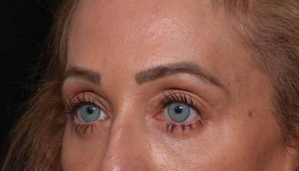 Brow Lift Before & After Patient #32830