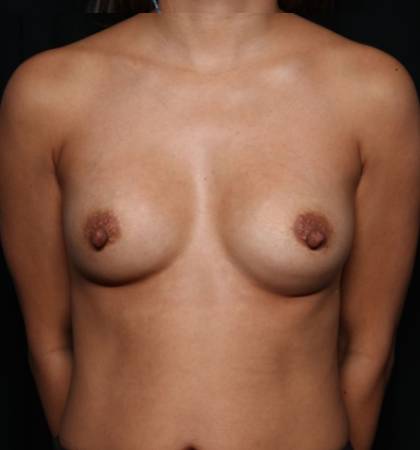 Breast Augmentation Before & After Patient #32841
