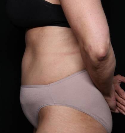 Liposuction Before & After Patient #32637