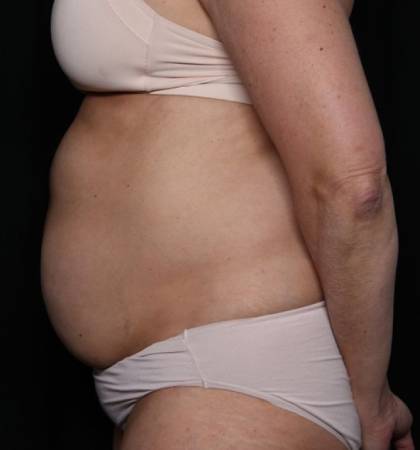 Liposuction Before & After Patient #32637