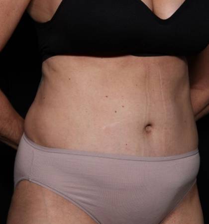 Liposuction Before & After Patient #32637