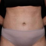 Liposuction Before & After Patient #32637