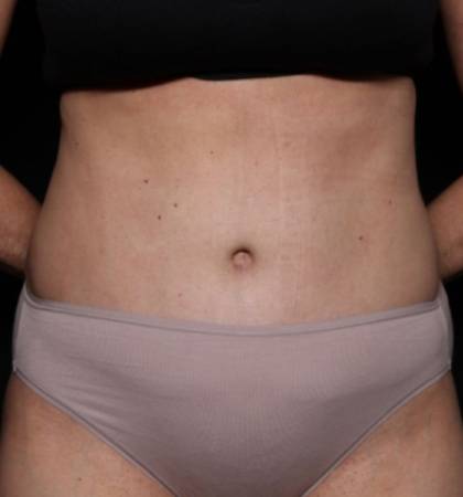 Liposuction Before & After Patient #32637