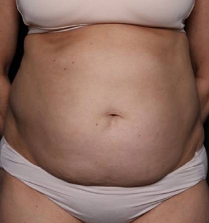 Liposuction Before & After Patient #32637