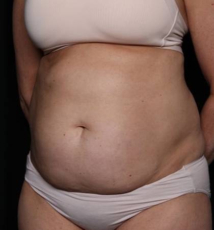 Liposuction Before & After Patient #32637